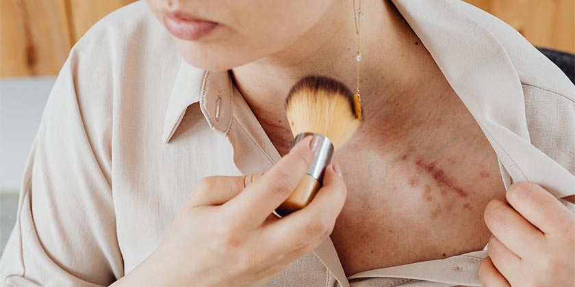 Ученые нашли способ навсегда избавиться от шрамов с помощью волосяных фолликулов