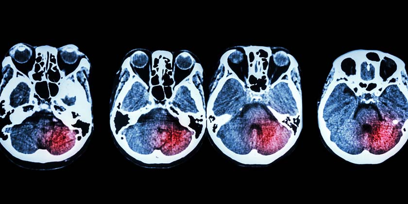 Искусственный интеллект, созданный в Израиле, на треть снизил смертность после инсультов