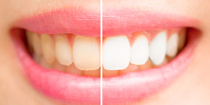 Как поменять рацион, чтобы сделать зубы белее