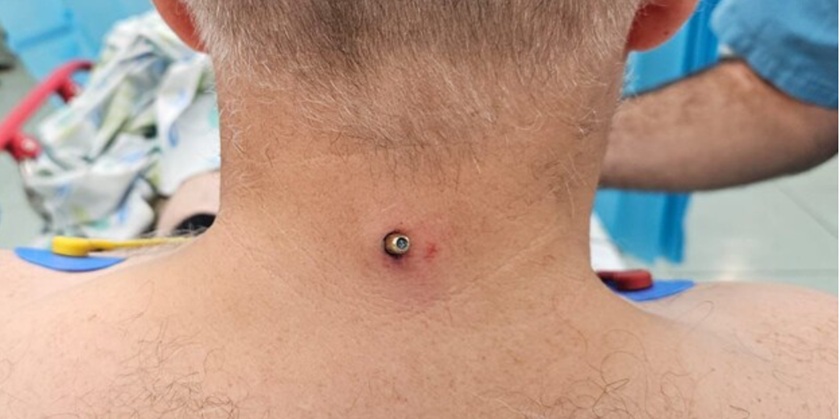 Чудом спасся: житель Маалота гулял в парке – и получил шальную пулю в шею